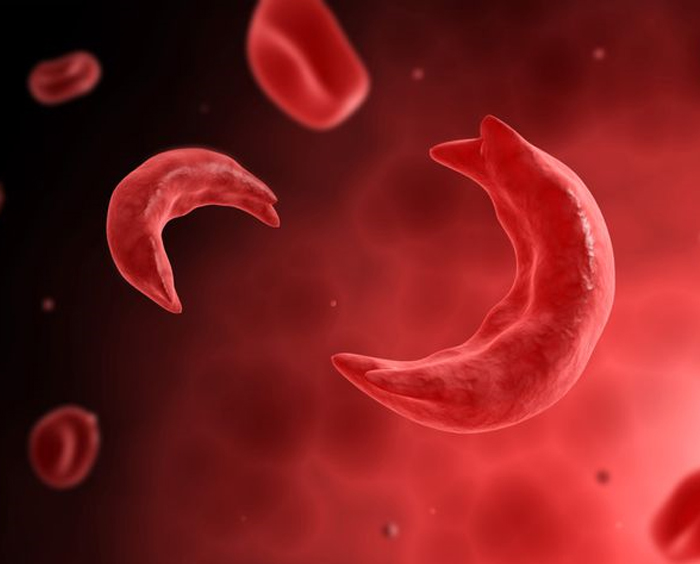 Microscopic view of sickle cell disease